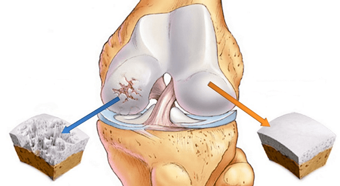 дени сак кемирчек жана артроз менен жабыркаган кемирчек